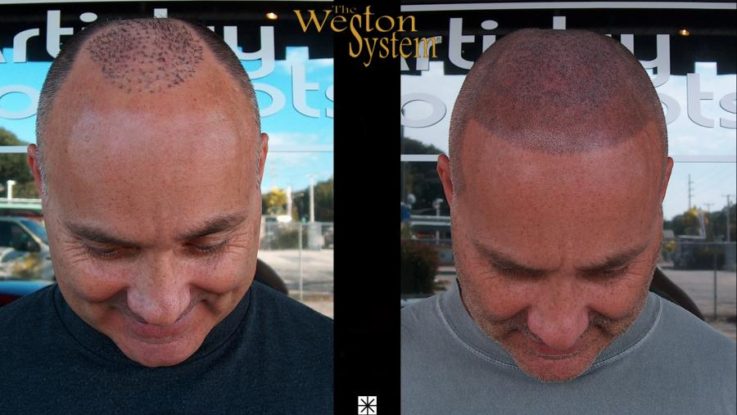 Failed Hair Transplant Victims Turn To Weston System℠ Patented Scalp Tattoo  Method - Florida Country Music Scene